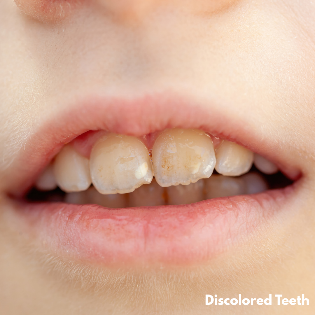 discolored teeth